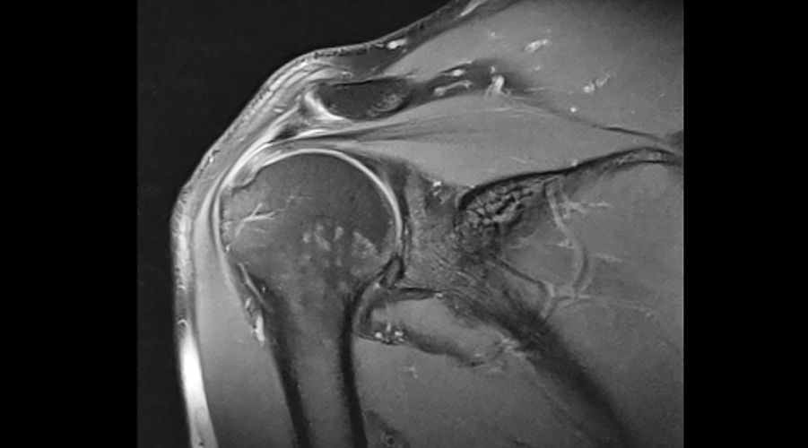 Shoulder Impingement Syndrome